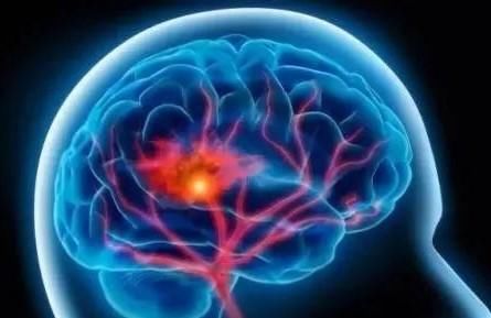  先兆|头晕、手发麻、言语不清？是脑梗先兆！4种食物让大脑年轻10岁