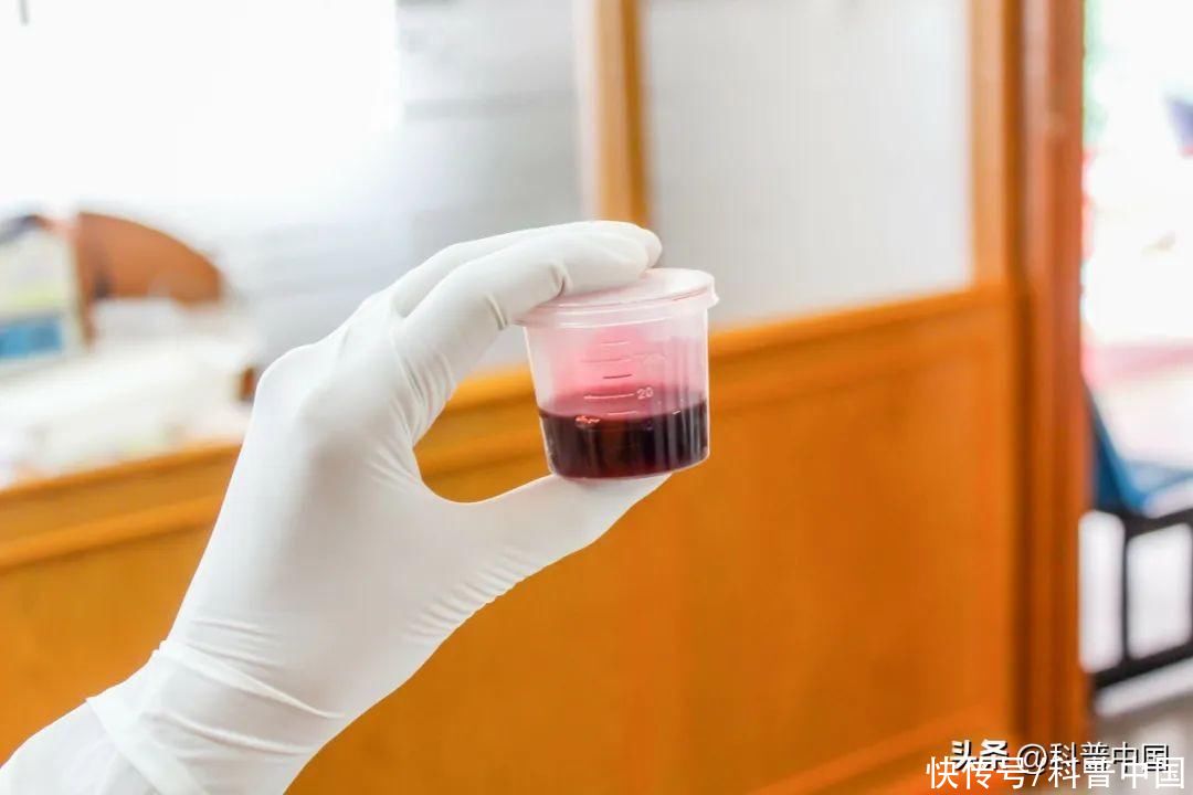 8种尿液颜色预示得了这些病(尿液变色是疾病前兆？关于尿液的 8 种颜色，一文说清！)