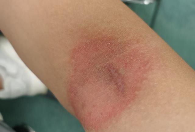 水疱|当心!这种虫子千万不能拍打!市民被隐翅虫叮红肿长水疱