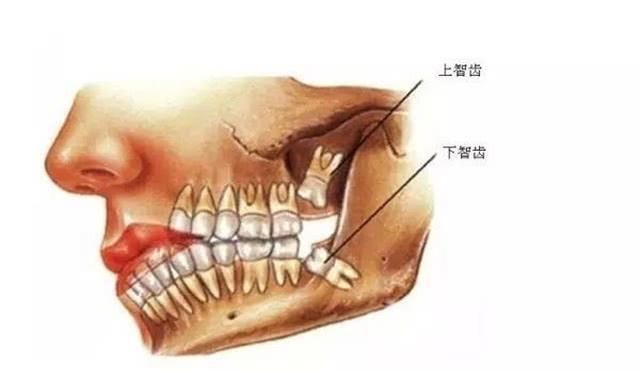  智齿|为什么拔出来的智齿会这么臭？听完医生的解释，觉得“难为情”