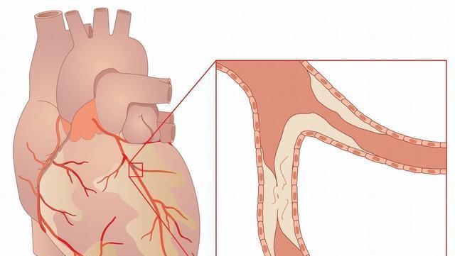冠心病|冠心病患者有福了,在心脏上架起“桥梁”,能让生命重获“心”生