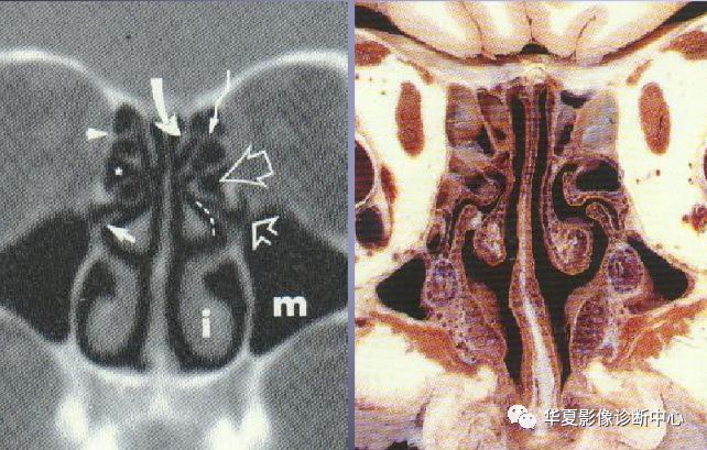 【影像基础】鼻窦窦口复合体解剖变异