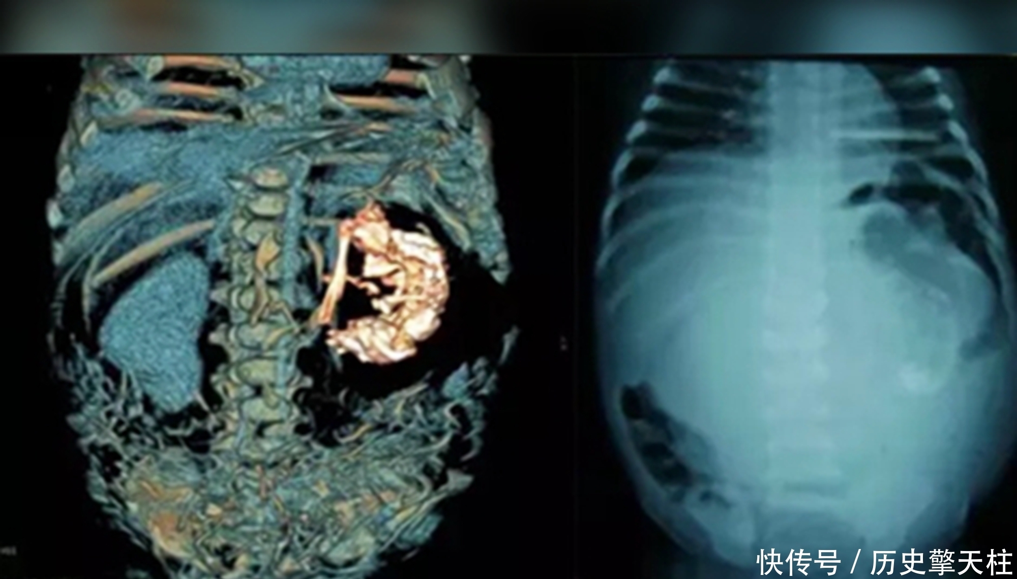 寄生|史上最小产妇非寄生胎,5岁产子打破生育极限,儿子称她“姐姐”