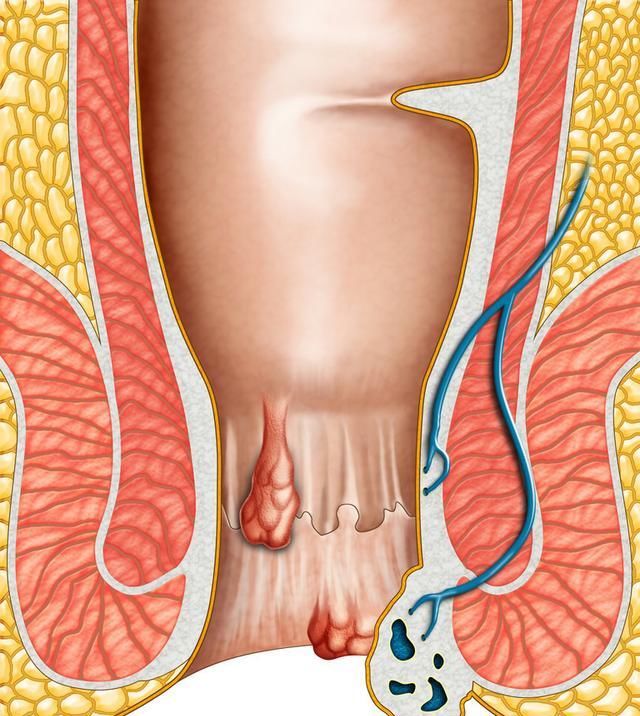  痔疮|如何消除痔疮肉球？这几个习惯要养成，消除特殊部位的困扰