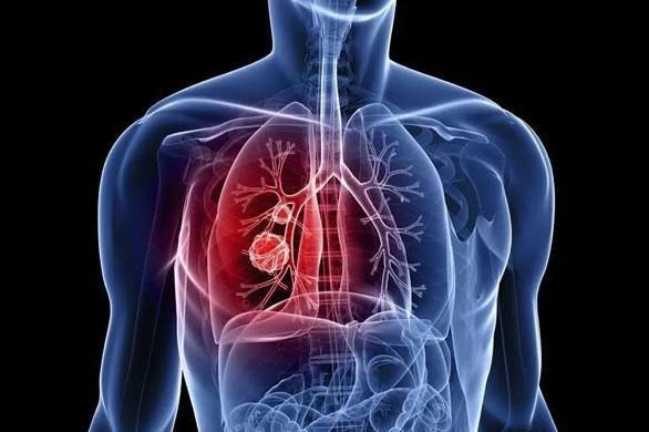  肺癌|奥希替尼有望用于早期肺癌，还能让软脑膜转移者活得更久