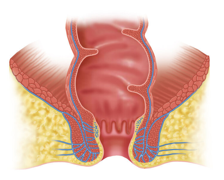 医生|28岁男子肛门疼痛,屁股被“掏空”医生半月前就有征兆