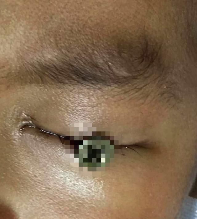  螺丝钉|泰男孩花园玩耍，父亲的割草机突然飞射螺丝钉，直刺眼球深插头骨