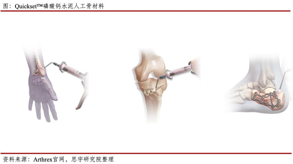 骨会|行业｜需要骨修复的患者越来越多，人工骨会是他们的救星吗？