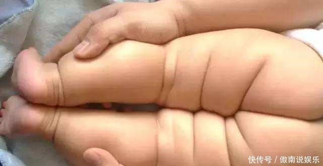  一家人|8个月宝宝的腿纹不一致，一家人发现的太晚，结果错过最佳治疗期