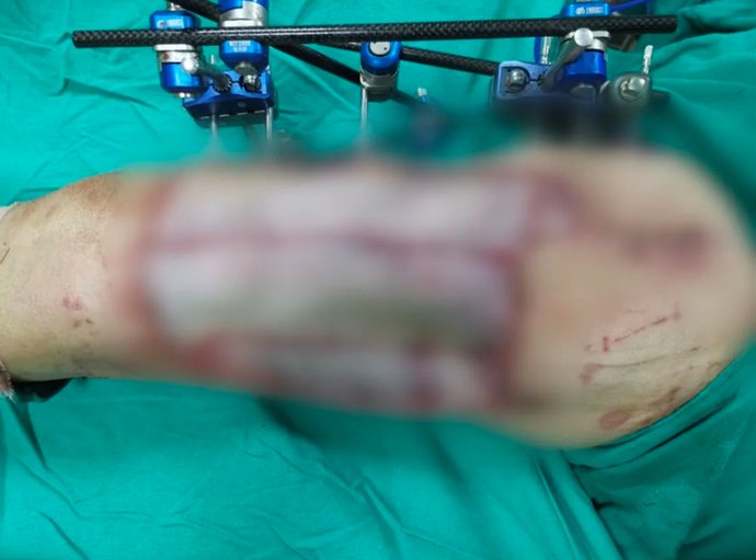 郑州人民医院|吓人！手机放裤兜爆炸险些炸断腿，这几大征兆一定要注意!