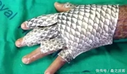  手臂|农村男子手臂意外烧伤，媳妇用鱼皮包裹，结果却让人惊喜
