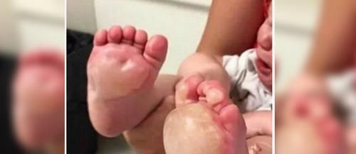  妈妈|妈妈回家才发现6月大女儿脚变成这样,保姆还假装自己不知情