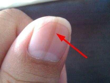 大拇指指甲上有竖纹是怎么回事?