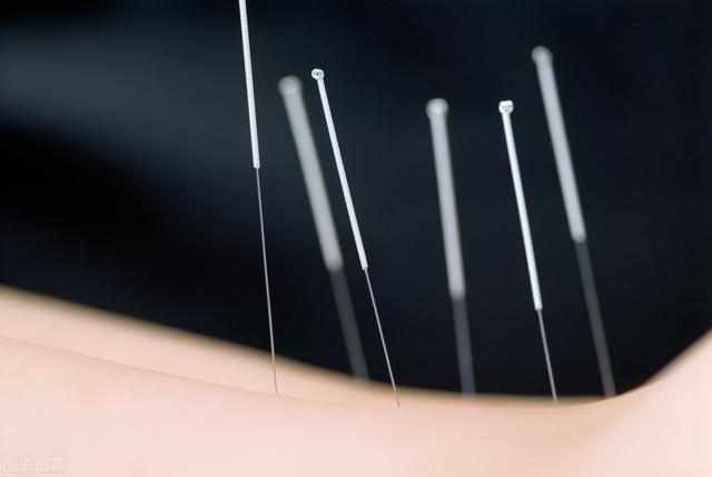  减肥|针灸减肥知多少？