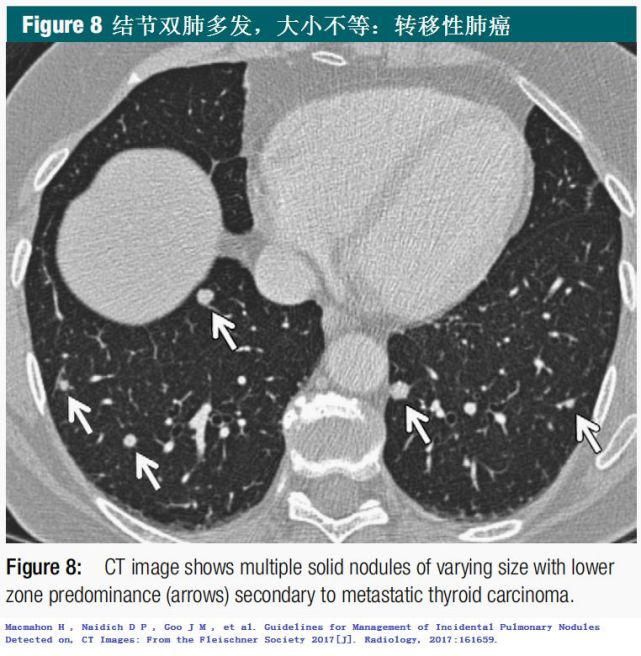  结节|肺结节切还是不切？20张经典图谱说明白了！