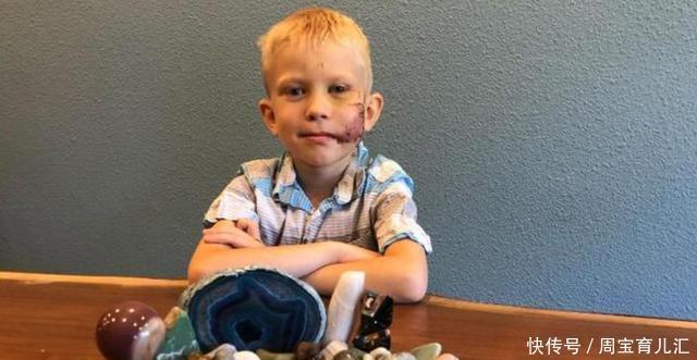  妹狂魔|“宁愿自己被咬死”6岁男孩为了救妹，遭疯狗咬伤，脸部缝了90针