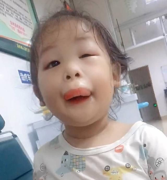 嘴巴|女儿吃芒果过敏,嘴巴2小时就肿成了“鸭子嘴”,亲妈笑出鹅叫声