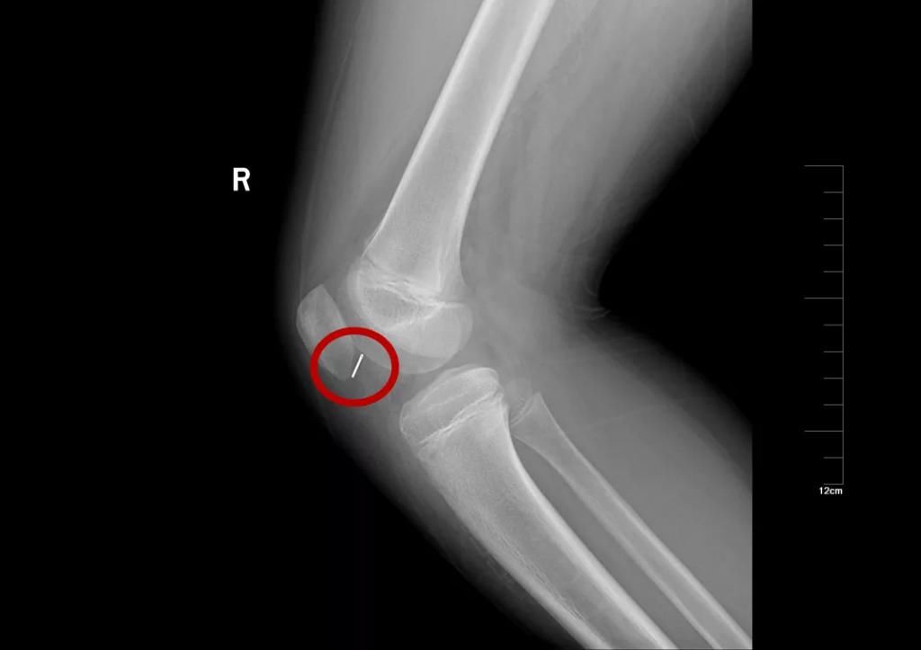  真相|有图有真相：那些年，孩子体内发现的硬币、钥匙、钉子、别针、电池……
