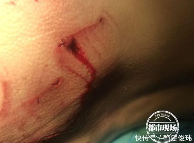  被迫|崩溃女子惨遭一群狗围攻，被迫逃入江中伤口触目惊心