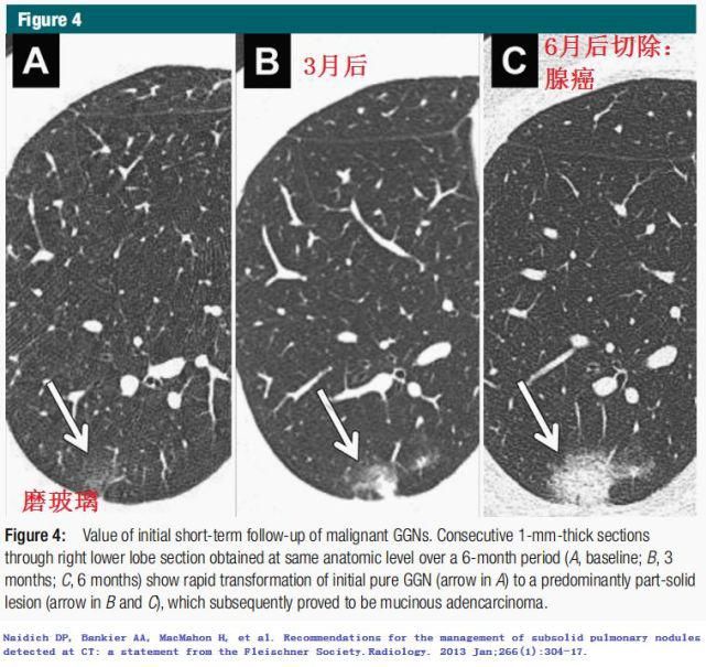  结节|肺结节切还是不切？20张经典图谱说明白了！