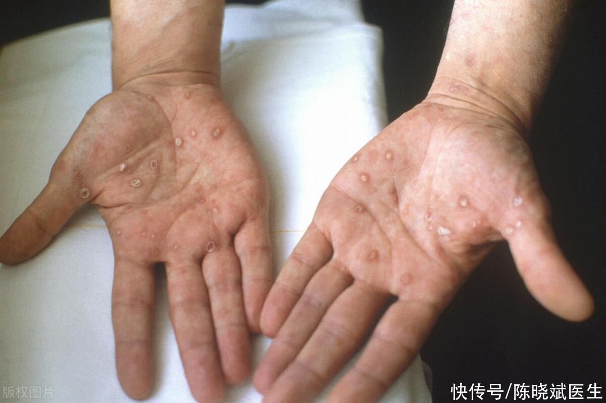 4种皮肤病会传染(一摸就被传染？3种皮肤病可能比你想的严重！出现红点抓紧治！)