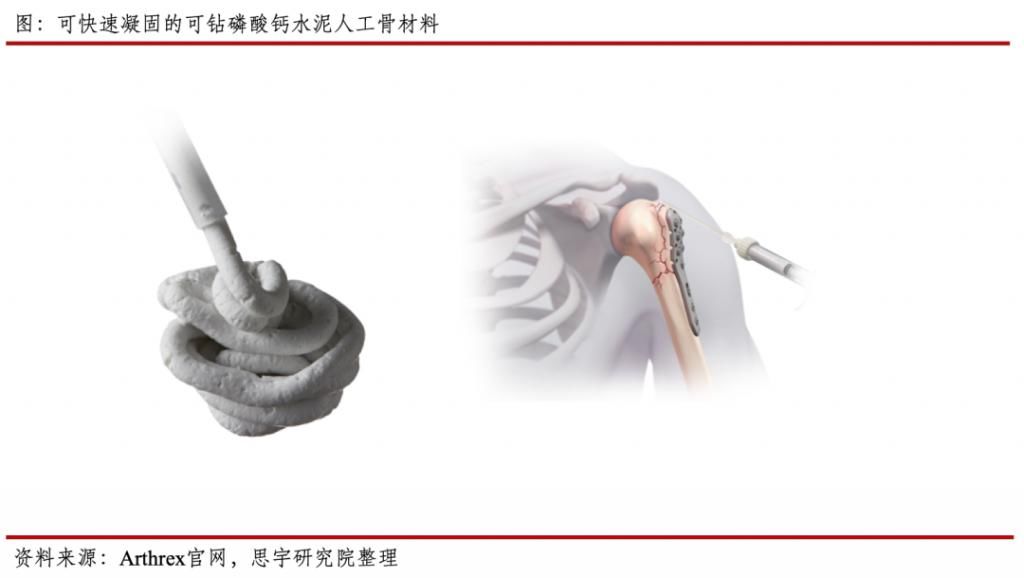 骨会|行业｜需要骨修复的患者越来越多，人工骨会是他们的救星吗？
