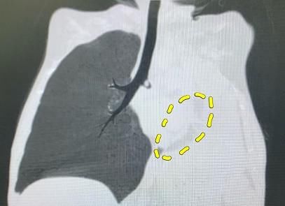  意外|【暖心】四岁男孩因车祸意外“丢”肺，“静止”一个月后得到“重启”