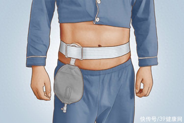 一个人没了肛门会怎样？“造口人”母亲半夜上吊自杀，被我发现了2023
