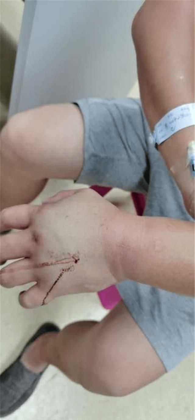  司机|毒蛇竟“从天而降”咬伤司机 急诊专家教你毒蛇咬伤急救指南