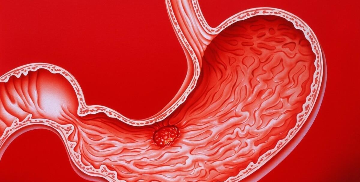  胃病|幽门螺杆菌“最怕”这5种药，医生：常喝口臭溜了，离胃病远远的