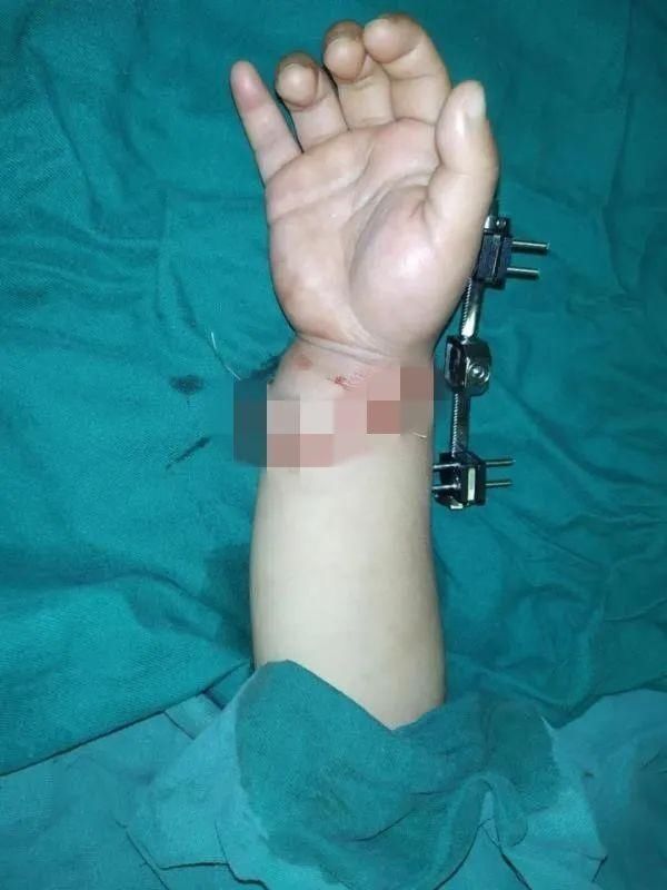  福州|福州2岁男童手臂被绞断！凶器很常见