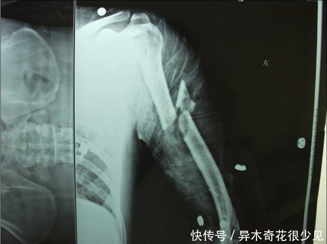 肿物|胳膊上有一个肿物,一碰还会痛有可能是骨肿瘤