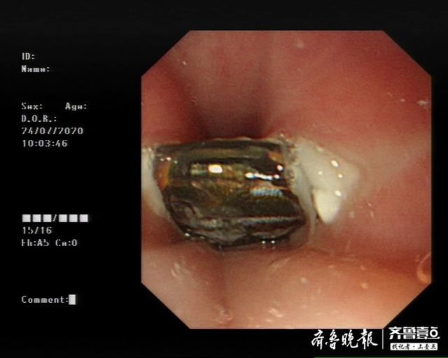 烟台山医院|小贴画也能引发大麻烦?烟台1岁半儿童误吞异物险酿大祸