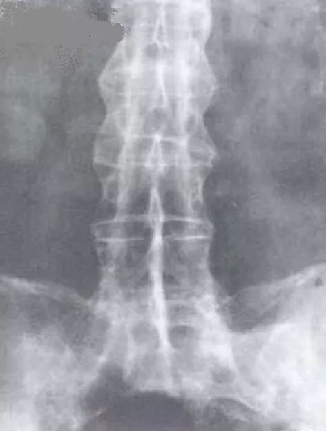 姑娘|姑娘订了婚,男友总喊腰疼,去医院一查……想退彩礼!