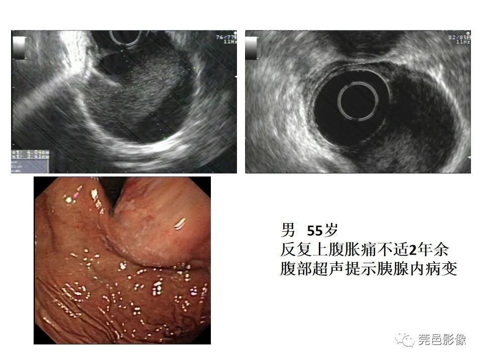 畸形|胃重复畸形CT诊断与鉴别诊断