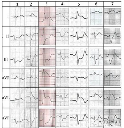冠状动脉|左主干闭塞的心电图表现