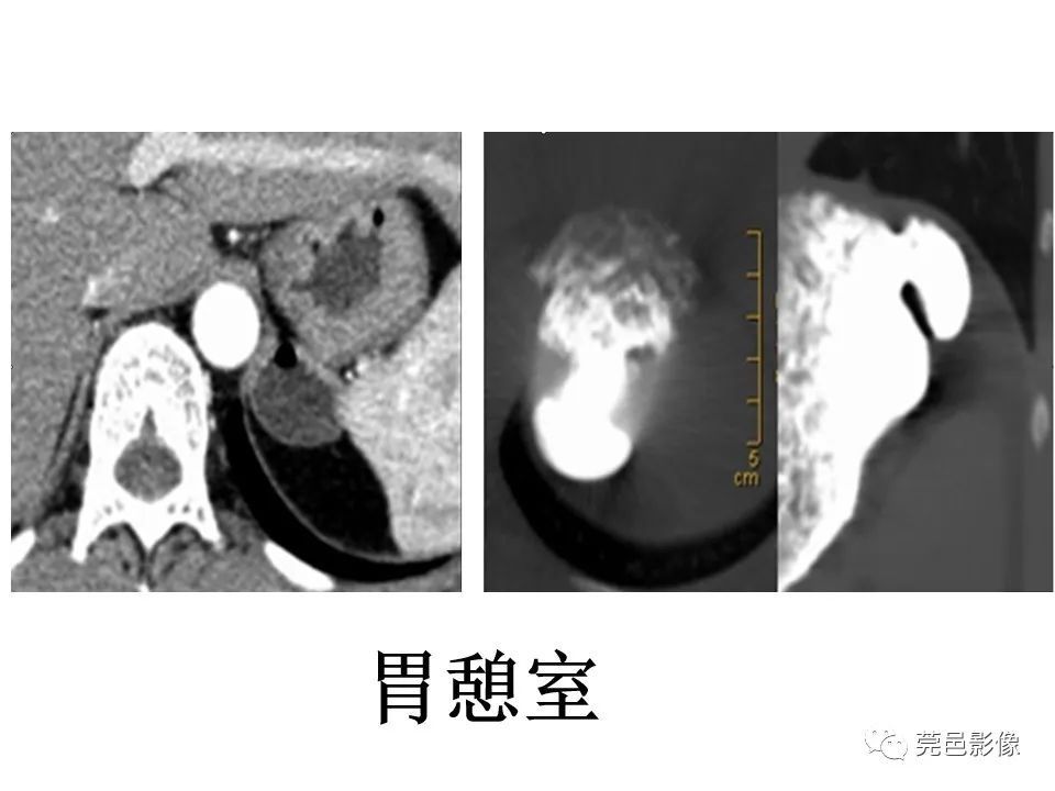 畸形|胃重复畸形CT诊断与鉴别诊断