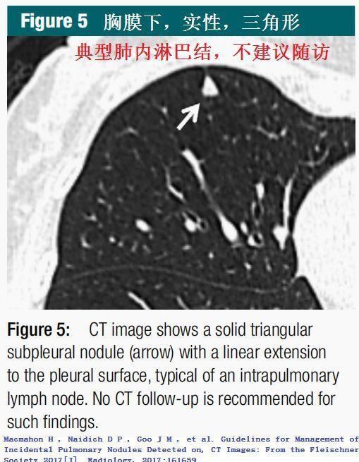  结节|肺结节切还是不切？20张经典图谱说明白了！