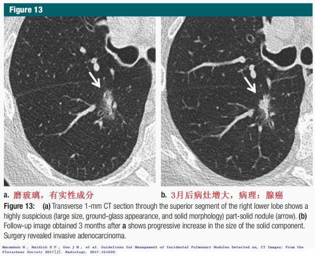  结节|肺结节切还是不切？20张经典图谱说明白了！