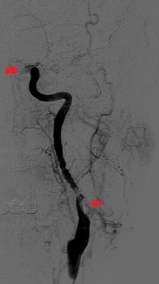  半身不遂|31岁年轻妈妈突发半身不遂 医生还原可怕的家庭真相