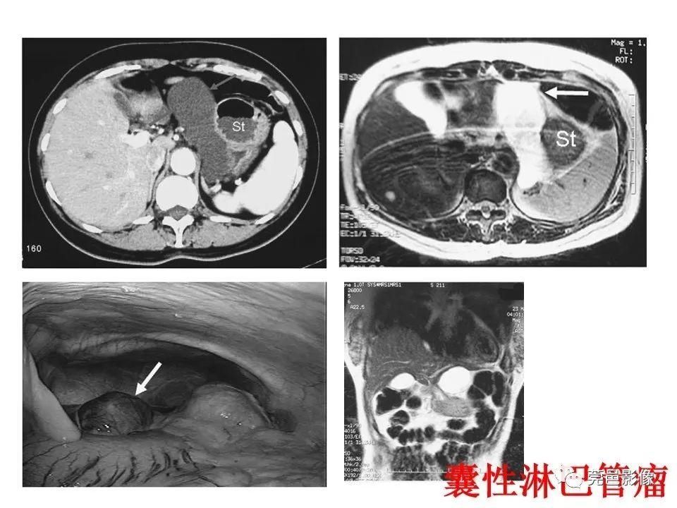 畸形|胃重复畸形CT诊断与鉴别诊断