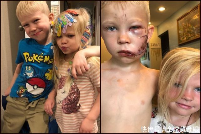  依旧|美6岁男孩为保护妹妹与恶狗搏斗，缝90针笑容依旧，获“绿巨人”盛赞