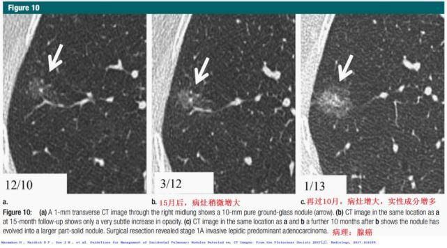  结节|肺结节切还是不切？20张经典图谱说明白了！