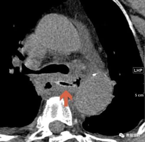 异物|杭州一女子胃内惊现14cm大勺子!原因竟是……