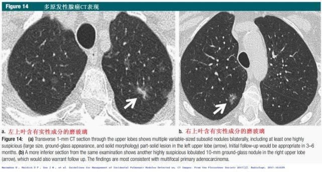  结节|肺结节切还是不切？20张经典图谱说明白了！