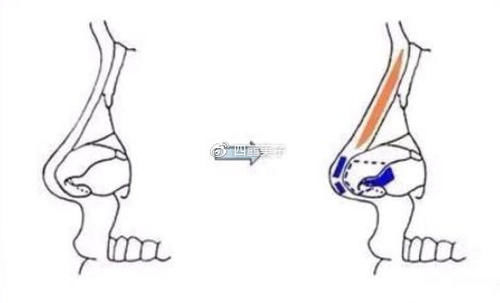 疤痕|隆鼻后疤痕增生怎么办？如何解决隆鼻疤痕呢？