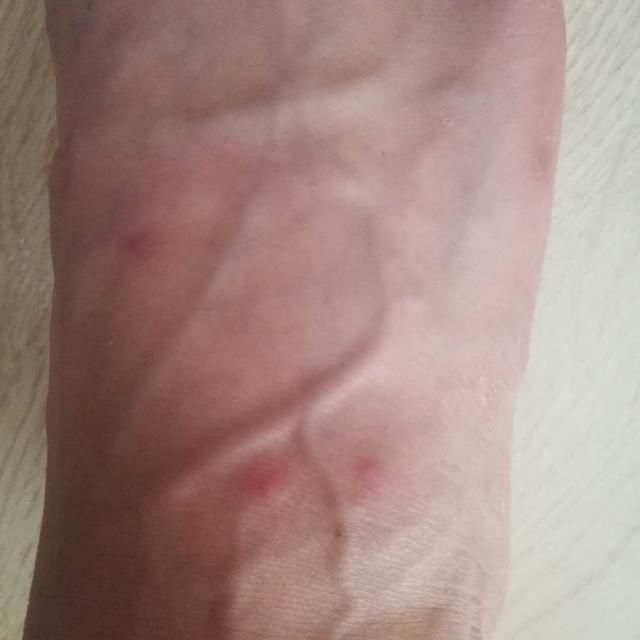 小心|在海边被咬,数天后仍旧奇痒难忍!夏季要小心它