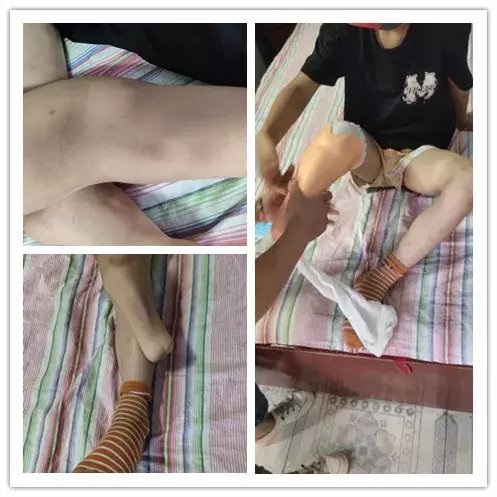  男孩|怒！酒驾将两岁男孩撞致截肢！67万赔偿苦等7年还没来！