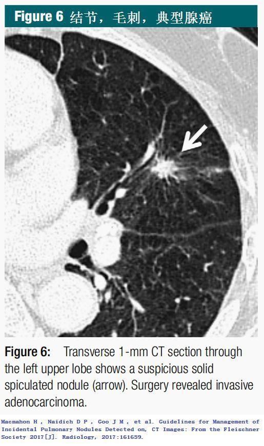  结节|肺结节切还是不切？20张经典图谱说明白了！