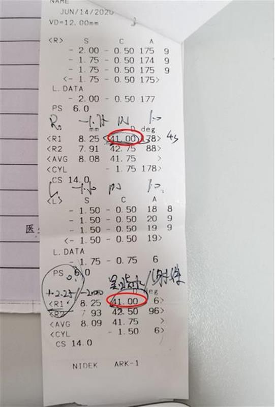 近视|低度数隐藏大危害!8岁女童眼睛里竟长出“豹纹”